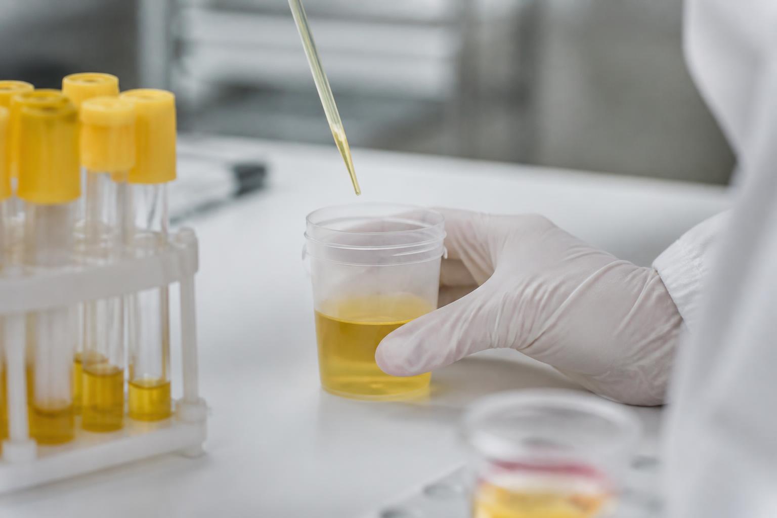 découvrez ce que signifie la présence de cellules épithéliales dans l'urine pendant la grossesse, et quand cela doit être considéré comme un signe d'alerte ou une simple préoccupation bénigne pour la future maman.